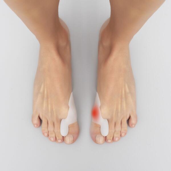 Corrector de Joanetes em Silicone - BunionFix™